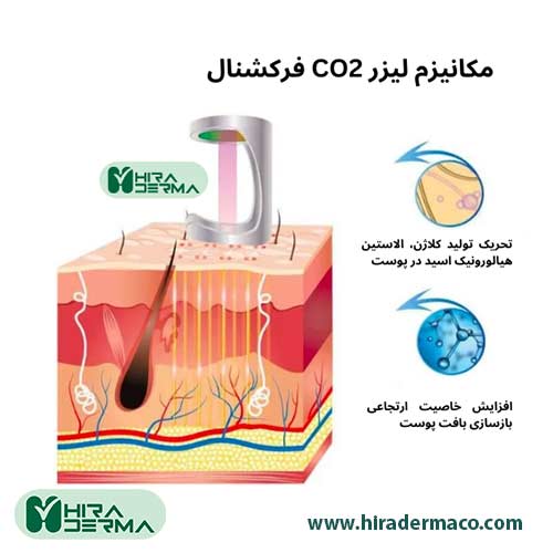 لیزر CO2 فرکشنال مکانیزم لیزر فرکشنال