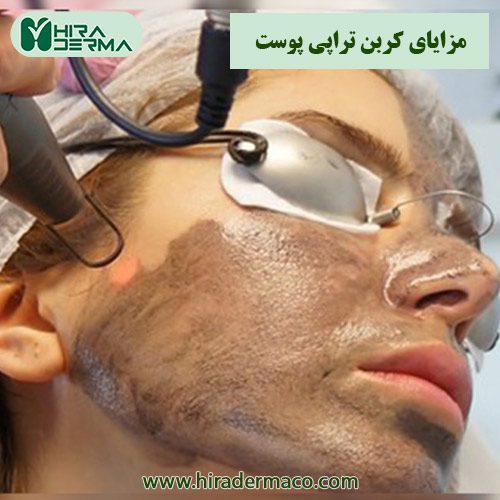 مزایای کربن تراپی پوست شرکت هیرادرما