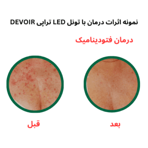 تونل LED دوویر