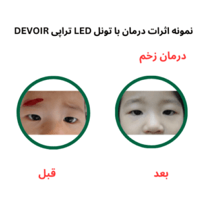 تونل LED دوویر