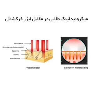 میکرونیدلینگ_طلایی_در_مقابل_لیزر_فرکشنال