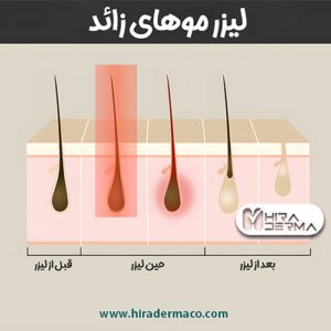 تفاوت لیزرهای الکساندریت ، دایود و ان دی یاگ لیزر موهای زائد