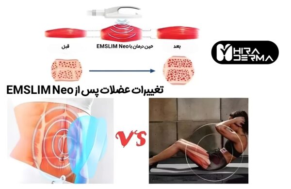 دستگاه لاغری، عضله سازی و فرم دهی EMSlim Neo