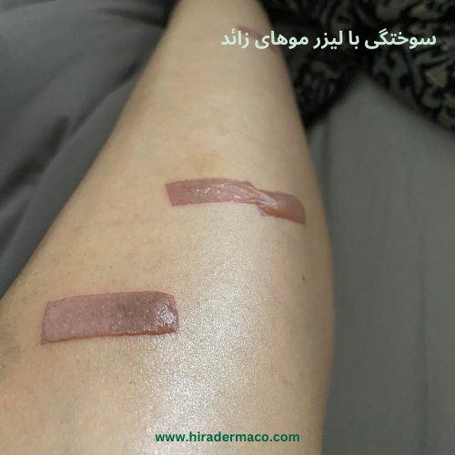 نمونه تصویر سوختگی با لیزر - هیرادرما پیشرو