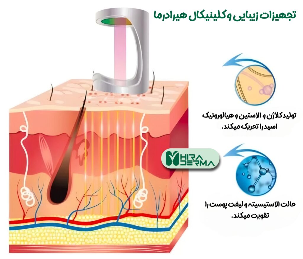 لیزر CO2 فرکشنال؛ انقلابی در جوانسازی و درمان مشکلات پوستی 1 فروشگاه هیر دراما لیزرتراپی با لیزر CO2 فرکشنال - هیرادرما پیشرو