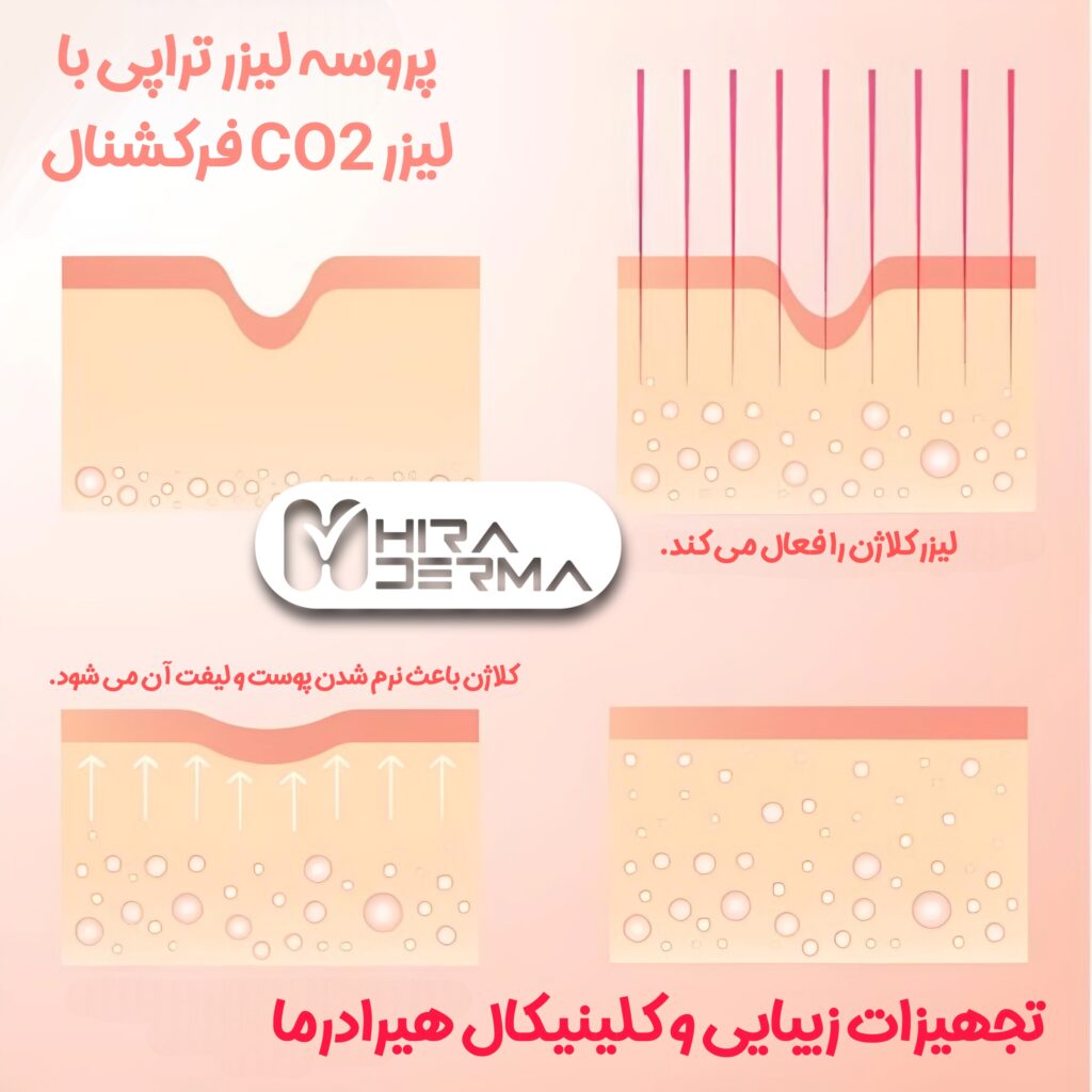 لیزر CO2 فرکشنال؛ انقلابی در جوانسازی و درمان مشکلات پوستی 2 فروشگاه هیر دراما جوانسازی با لیزر CO2 فرکشنال - هیرادرما پیشرو